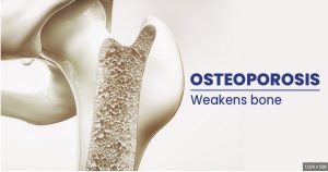 KEDI-OSTEOPOROSIS-ARTICLE